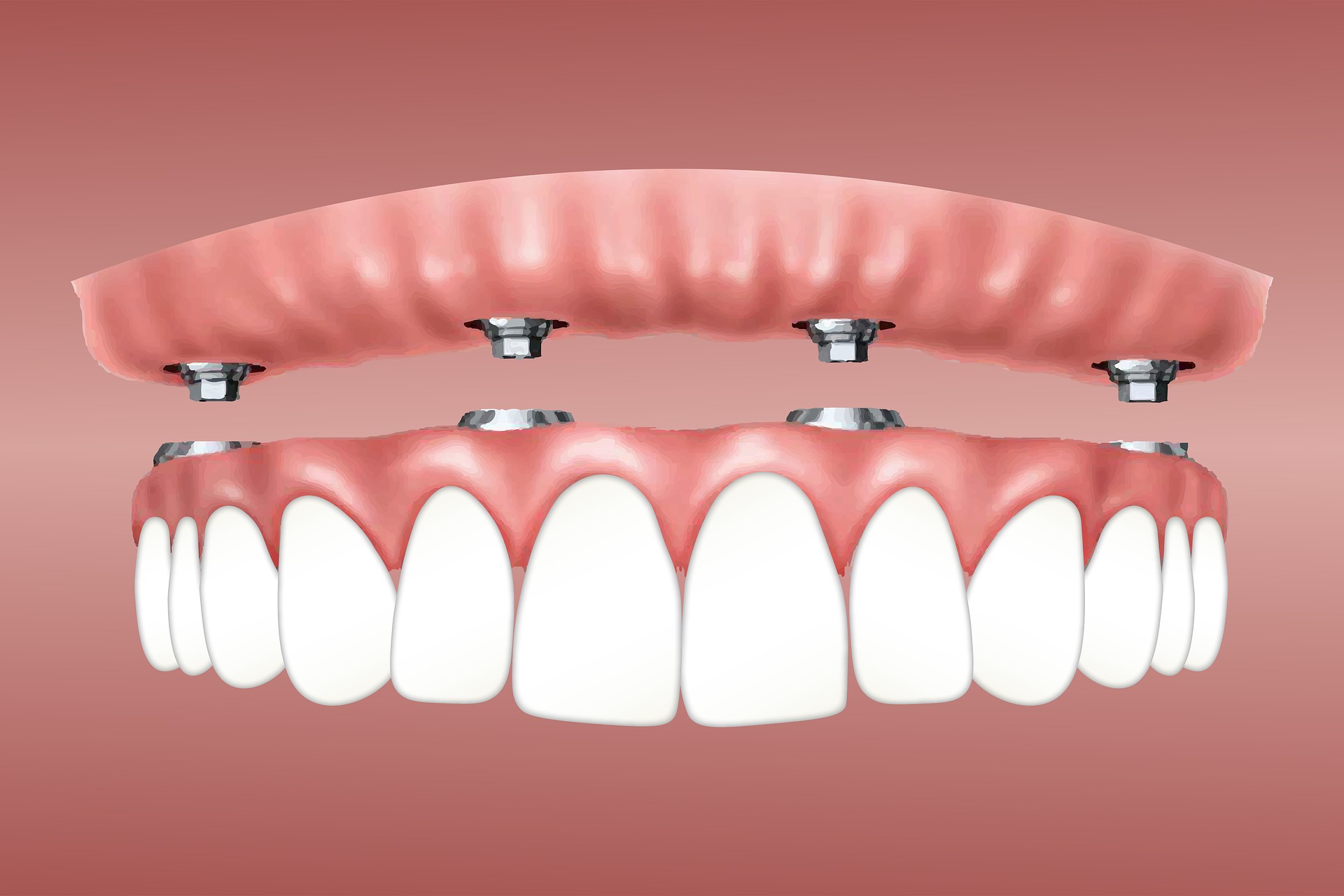 IMPLANT SUPPORTED REMOVABLE DENTURES